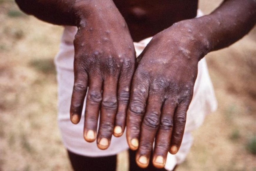 Monkeypox Outbreak in Kenya 2024: What to Know